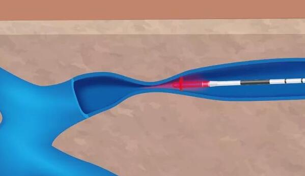 面向醫美市場 瑞波光電發布新型1470nm/1550nm激光芯片